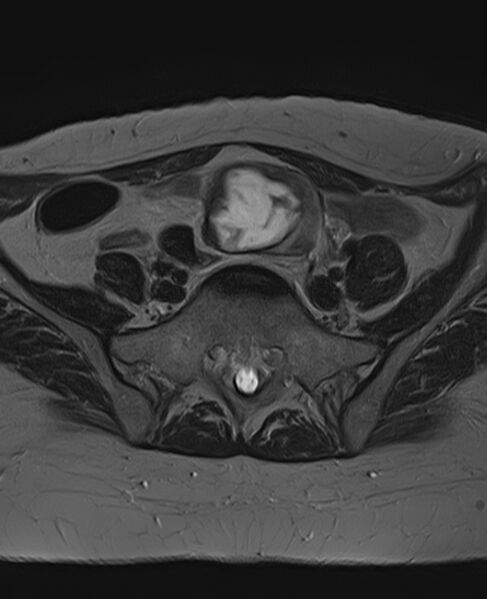 File:Adult granulosa cell tumor of the ovary (Radiopaedia 71581-81950 Axial T2 7).jpg