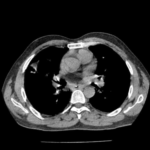 File:Airway foreign body in adult (Radiopaedia 85907-101779 Axial liver window 84).jpg