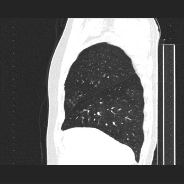 File:Allergic bronchopulmonary aspergillosis (Radiopaedia 21386-21320 Sagittal lung window 16).jpg