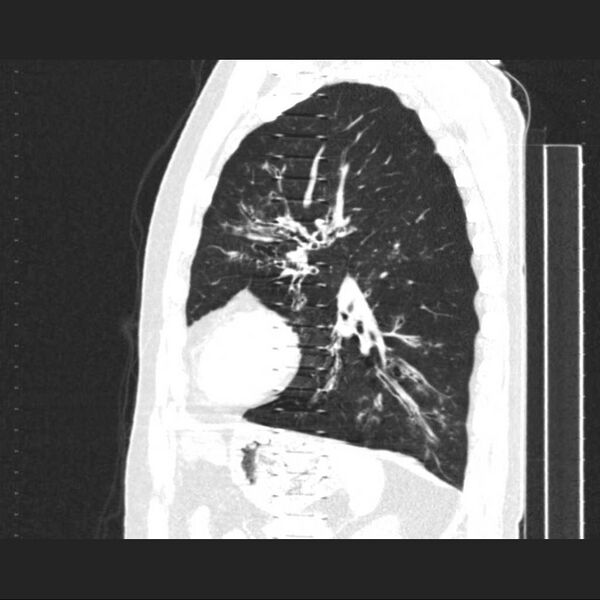 File:Allergic bronchopulmonary aspergillosis (Radiopaedia 21386-21320 Sagittal lung window 6).jpg