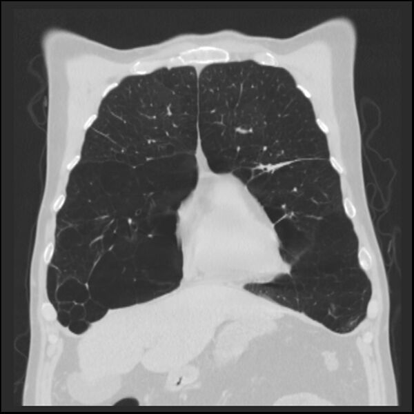 File:Alpha-1-antitrypsin deficiency (Radiopaedia 40993-43722 Coronal lung window 24).jpg