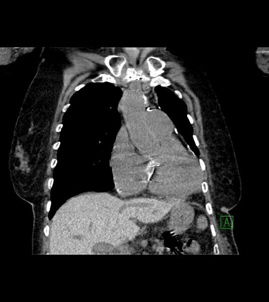 File:Amiodarone deposition in the liver (Radiopaedia 77587-89780 Coronal non-contrast 30).jpg