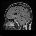 Amnestic syndrome secondary to hypoxic brain injury (Radiopaedia 24743-25004 D 11).jpg
