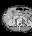 Ampulla of Vater metastasis (Radiopaedia 27820-28065 A 2).jpg