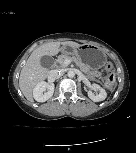 File:Ampulla of Vater metastasis (Radiopaedia 27820-28069 A 36).jpg