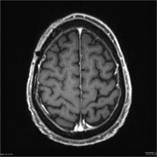 File:Anaplastic meningioma with recurrence (Radiopaedia 34452-35788 Axial T1 C+ 121).jpg