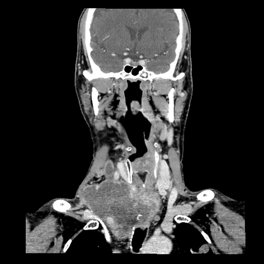 Anaplastic thyroid carcinoma (Radiopaedia 79087-92034 A 59).jpg