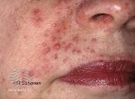 Angiofibromas in tuberous sclerosis (DermNet NZ systemic-s-tuberous-sclerosis07).jpg