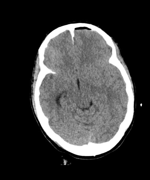 File:Angiomatous meningioma (Radiopaedia 79459-92578 Axial non-contrast 13).jpg