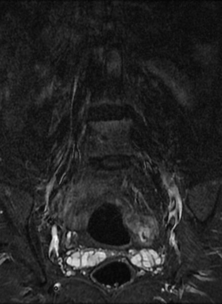 File:Ankylosing spondylitis - Andersson lesion (Radiopaedia 81878-95838 Coronal STIR 3).jpg