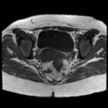 Ano-vaginal fistula (Radiopaedia 29765-30284 Axial T1 16).jpg