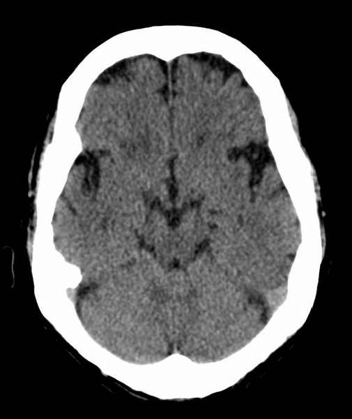 File:Anomalous intracranial venous drainage (Radiopaedia 28161-28418 Axial 33).png
