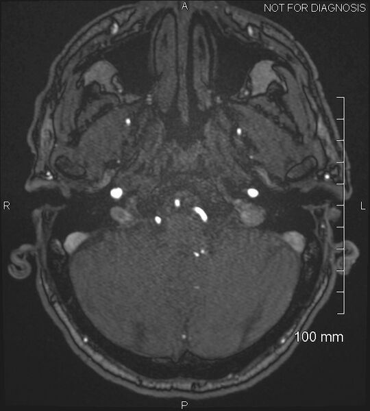 File:Anterior cerebral artery aneurysm (Radiopaedia 80683-94127 Axial MRA 37).jpg