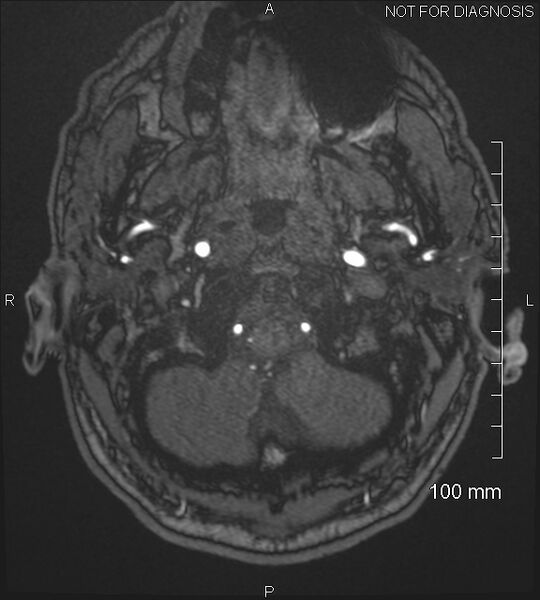 File:Anterior cerebral artery aneurysm (Radiopaedia 80683-94127 Axial MRA 9).jpg