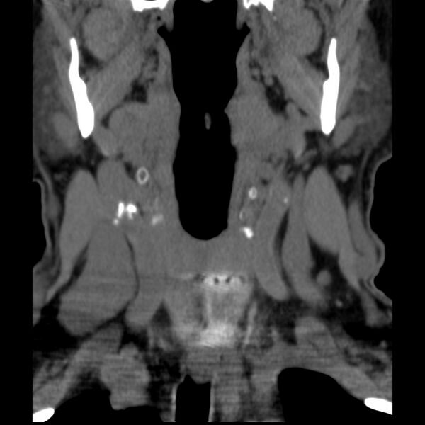 File:Anterior cervical postdiscectomy arthrodesis (Radiopaedia 32678-33646 Coronal non-contrast 3).jpg