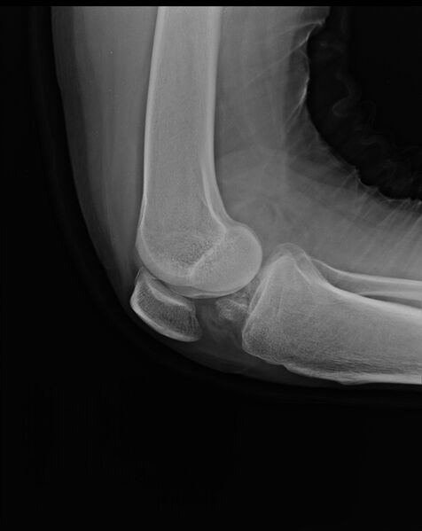 File:Anterior cruciate ligament bony avulsion (Radiopaedia 12579-12800 Lateral 1).jpg