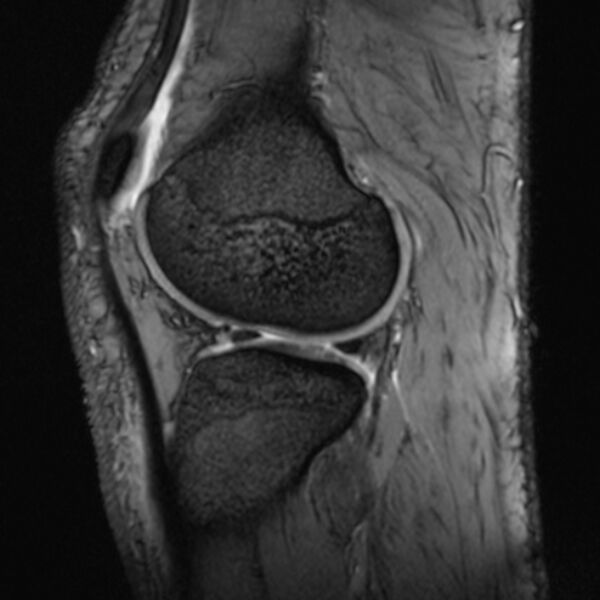 File:Anterior cruciate ligament tear - ramp lesion (Radiopaedia 71883-82322 Sagittal T2 fat sat 8).jpg