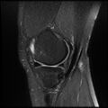 Anterior cruciate ligament tear with posteromedial corner injury, bucket-handle meniscal tear and chondral delamination (Radiopaedia 75501-86744 Sagittal PD fat sat 6).jpg