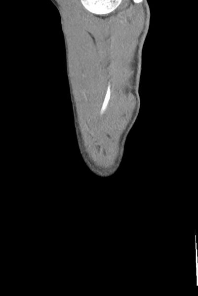 File:Aortic coarctation with aneurysm (Radiopaedia 74818-85828 B 160).jpg