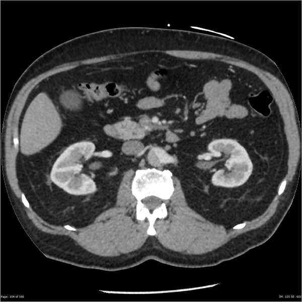 File:Aortic dissection- Stanford A (Radiopaedia 37759-39664 A 95).jpg