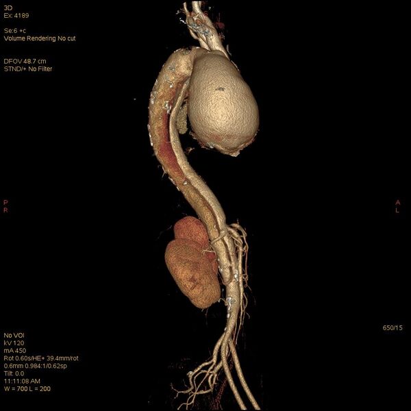 File:Aortic dissection (Radiopaedia 25350-25604 E 15).jpg