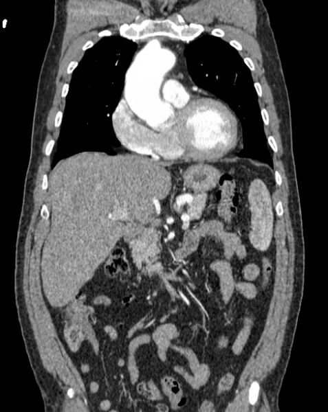 File:Aortic dissection (Radiopaedia 44411-48061 A 10).jpg