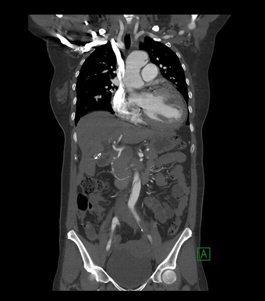File:Aortic dissection with renal ischemia (Radiopaedia 76573-88338 C 8).jpg