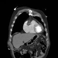 Aortic dissection with rupture into pericardium (Radiopaedia 12384-12647 B 6).jpg