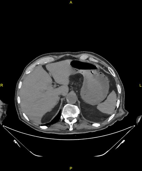 File:Aortoenteric fistula (Radiopaedia 84308-99603 Axial non-contrast 59).jpg