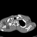 Aortopulmonary window, interrupted aortic arch and large PDA giving the descending aorta (Radiopaedia 35573-37074 B 7).jpg