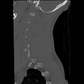 Apical pneumothorax on cervical spine CT (Radiopaedia 45343-49368 Sagittal bone window 32).jpg