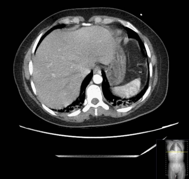 File:Appendicitis (CT angiogram) (Radiopaedia 154713-127660 Axial 170).jpg