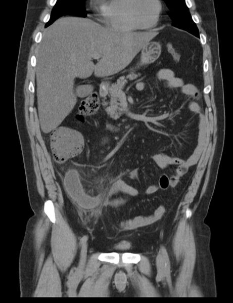 File:Appendicitis and giant appendicolith (Radiopaedia 80251-93588 Coronal non-contrast 17).jpg