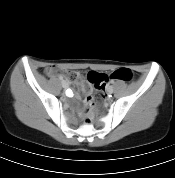 File:Appendicitis and incidental bicornuate uterus (Radiopaedia 22833-22853 Axial C+ delayed 31).jpg