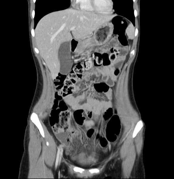 File:Appendicitis and incidental bicornuate uterus (Radiopaedia 22833-22853 D 11).jpg