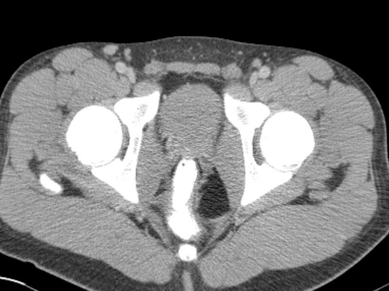 File:Appendicitis and incidental foregut duplication cyst (Radiopaedia 52962-58916 A 101).jpg