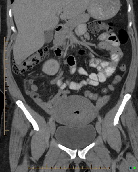 File:Appendicitis post recent cesarian section (Radiopaedia 29594-30102 D 11).jpg