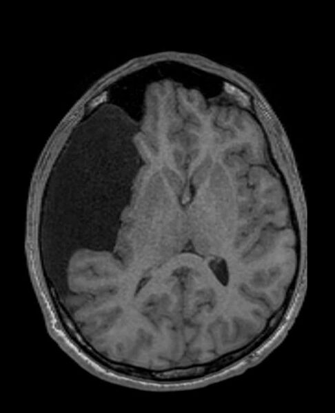 File:Arachnoid cyst- extremely large (Radiopaedia 68741-78451 Axial T1 41).jpg