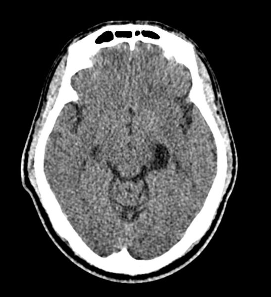 File:Arachnoid cyst of the ambient cistern (Radiopaedia 81301-94986 Axial non-contrast 30).jpg