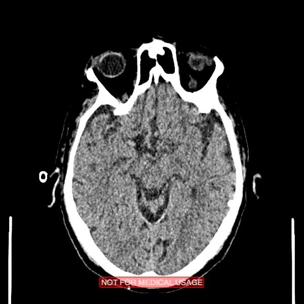 File:Artery of Percheron infarction (Radiopaedia 28679-28967 Axial non-contrast 50).jpg