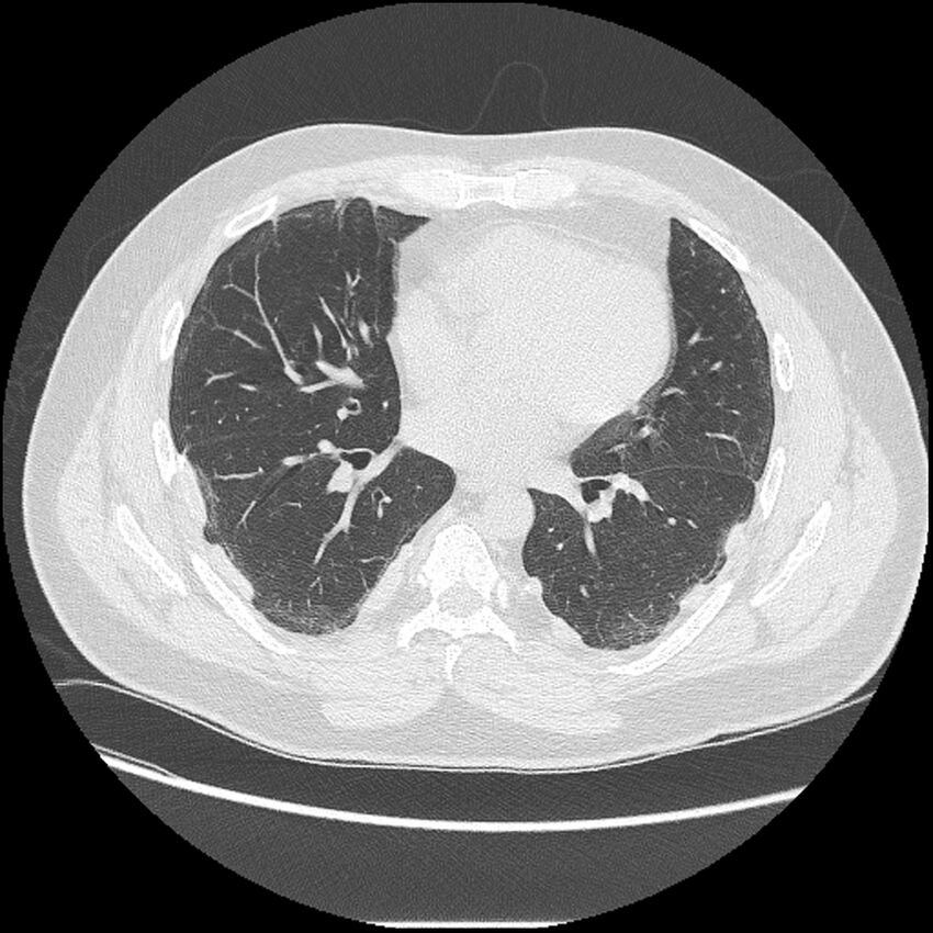 Asbestosis (Radiopaedia 45002-48961 Axial lung window 29).jpg
