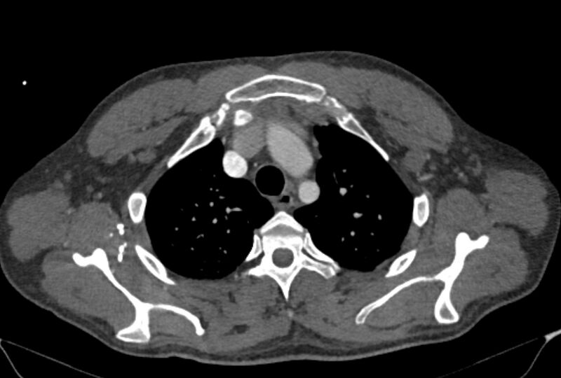 File:Ascending aortic aneurysm (Radiopaedia 86279-102297 C 10).jpg
