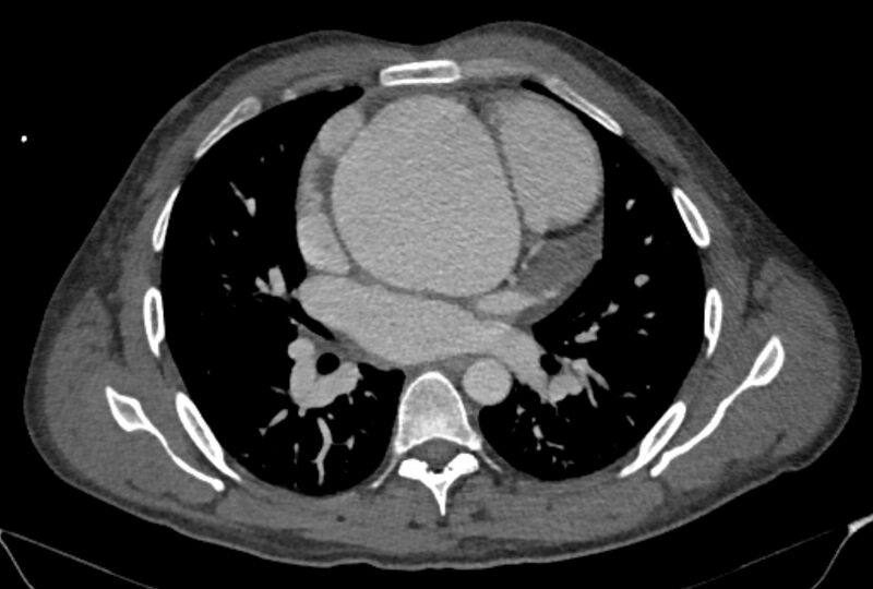 File:Ascending aortic aneurysm (Radiopaedia 86279-102297 C 31).jpg