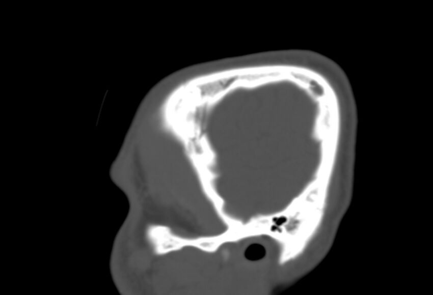 Asymptomatic occipital spur (Radiopaedia 87753-104201 Sagittal bone window 18).jpg