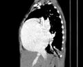 Atrial septal defect complicated by Eisenmenger syndrome (Radiopaedia 53707-59768 Sagittal C+ CTPA 10).jpg