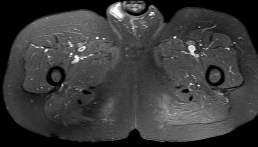 Atypical lipomatous tumor - thigh (Radiopaedia 68975-78734 Axial PD fat sat 74).jpg