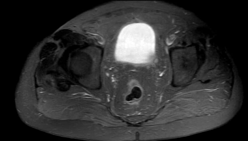 Atypical lipomatous tumor - thigh (Radiopaedia 68975-78734 Axial PD fat sat 97).jpg