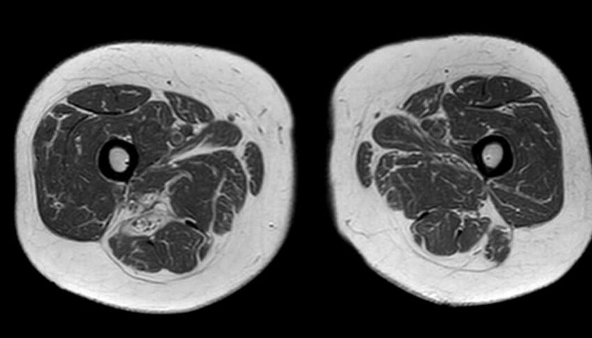 Atypical lipomatous tumor - thigh (Radiopaedia 68975-78734 Axial T1 61).jpg
