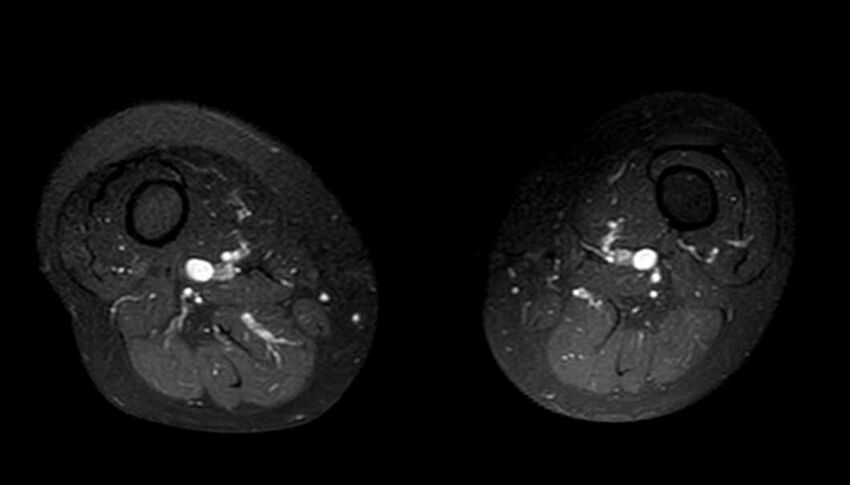 Atypical lipomatous tumor - thigh (Radiopaedia 68975-78734 Axial T1 C+ fat sat 36).jpg