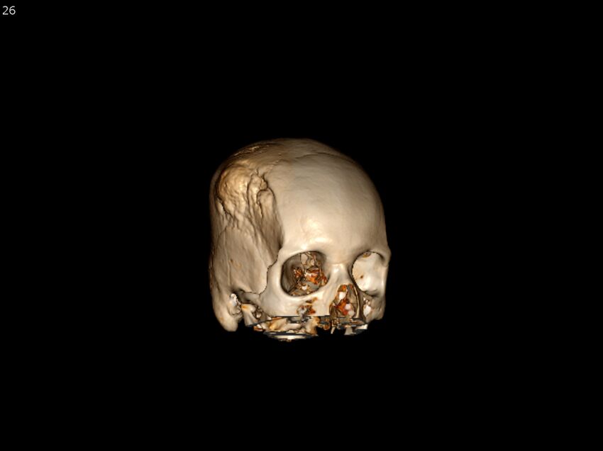 Atypical meningioma - intraosseous (Radiopaedia 64915-73867 3D volume render 26).jpg